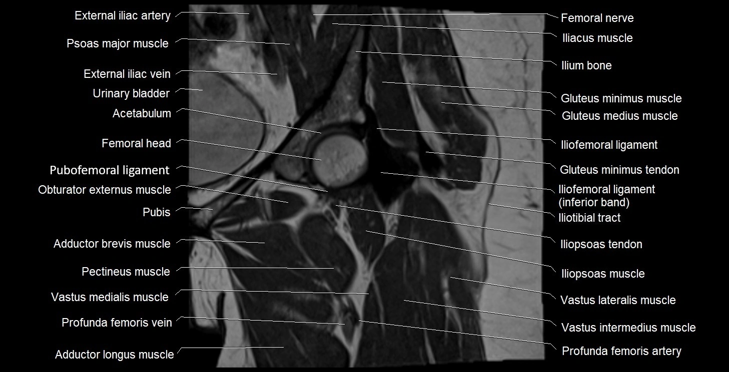 MRI Hip 3T coronal cross sectional anatomy image 24.webp